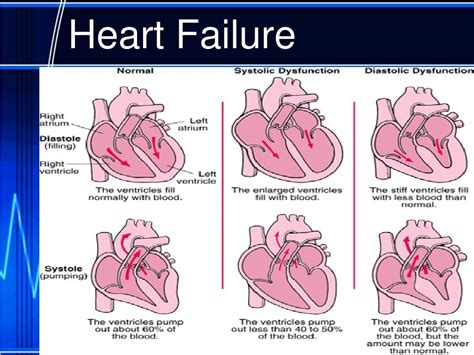 The Pathophysiology Of Hypertensive Acute Heart Failure Heart