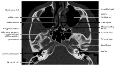 Cranial Bone Anatomy Ct Axial