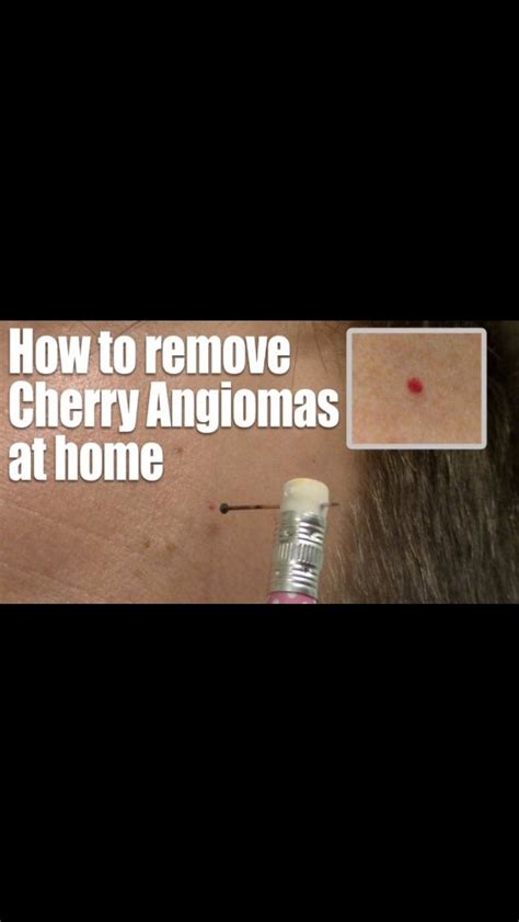 How To Remove Cherry Angioma Skin Health Natural Healing How To Remove