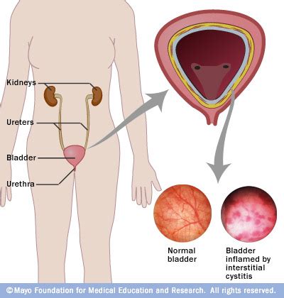 Read about the causes for the development of endometriosis, a disease that affects the female reproductive system, causing pain and infertility. Survival Arrival: Living with Interstitial Cystitis, IBS ...