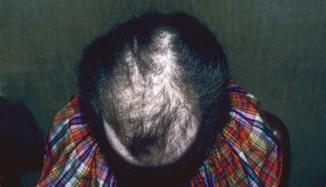 Physical stability, hair growth activity on rats, and safety test. The most common causes of hair loss among women - The ...