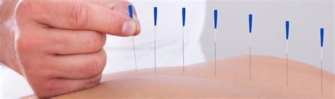 what is dry needling wickford chiropractic clinic