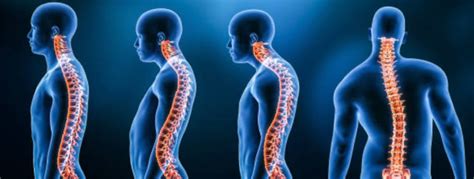 Kyphosis Causes Symptoms And Treatment Socal Scoliosis Care