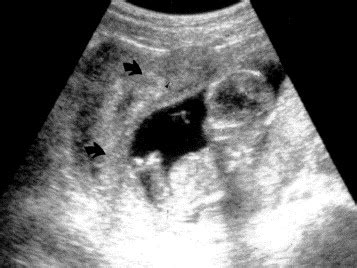 Complete Septate Uterus With Longitudinal Vaginal Septum Fertility