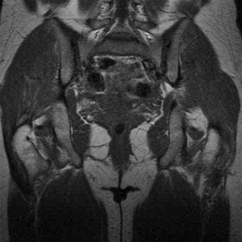 Ovarian Dermoid Cyst Mri Radiology Case
