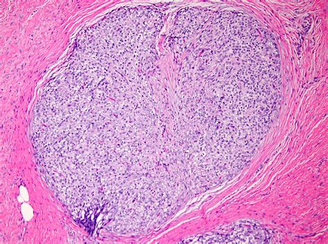 Pathology Outlines Ossifying Fibromyxoid Tumor