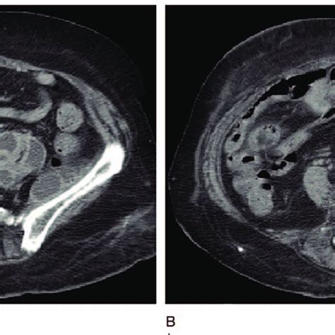 Contrast Enhanced Ct Scan Demonstrating Multilocular Abscess With