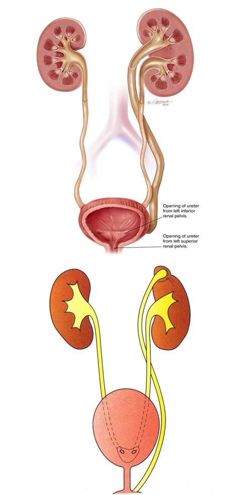 e-Newyest: Ureter Ektopik (Ectopic Ureter)