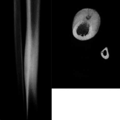 Another Case On Osteoid Osteoma In An Adult Patient The First Image Is