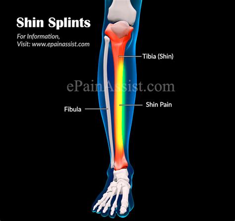 Shin Splints Shinbone Pain Treatment Brace