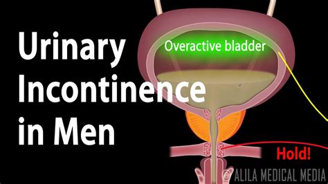 Urinary Incontinence In Men Animation YouTube