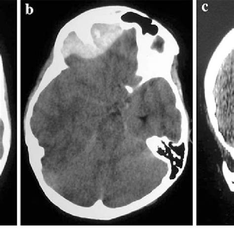 Ct Scan Showing A Right Frontal Extradural Hematoma With Mass Effect On