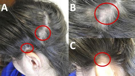 Top 100 Black Dots On Scalp Hair Loss Polarrunningexpeditions