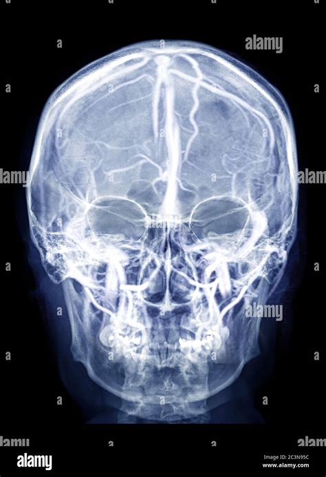 Imagen de radiografía del cráneo humano Vista AP mezcla con MRV imagen