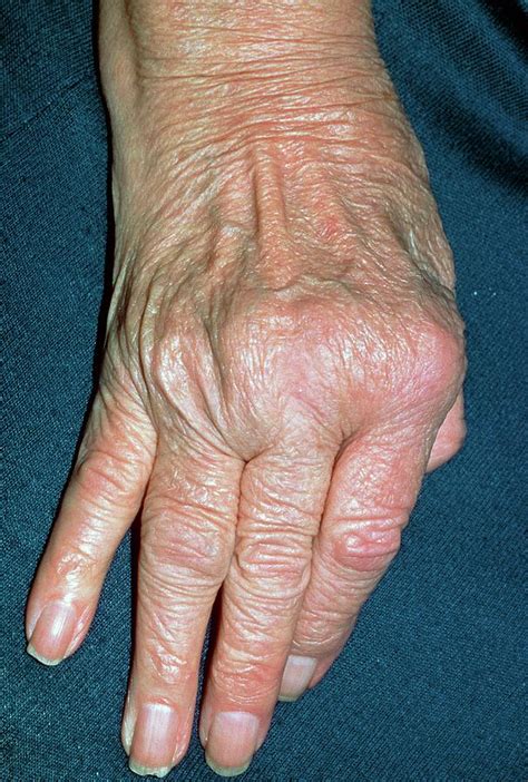 Rheumatoid Arthritis Of Hand With Ulnar Deviation Photograph By Science