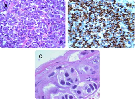 Merkel cell carcinoma occurs when something goes wrong within these cells and causes them to grow uncontrollably. Merkel cell carcinoma in a patient with noninvasive vulvar Paget's disease - American Journal of ...