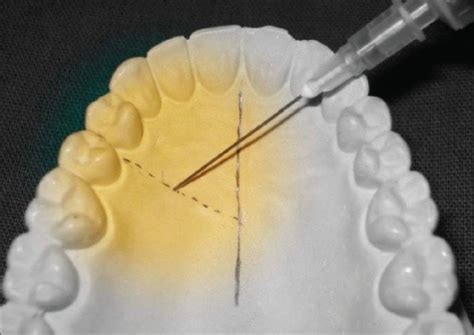 Anterior Middle Superior Alveolar Nerve Block Dental Injection Amsa
