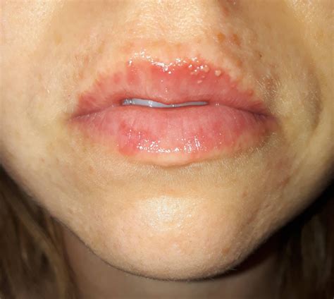 Scaly Dry Skin Around My Mouth Blisters On Lips After Using Tretinoin