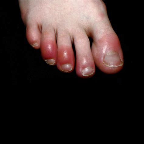Covid Toe Rash Pictures Covid Toes Could Skin Conditions Offer