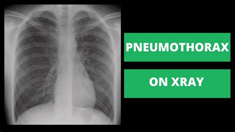 How To Identify A Pneumothorax On Xray Strategies From A Radiologist Youtube