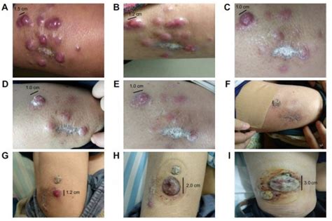Merkel cell carcinoma (mcc) is a rare, aggressive form of skin cancer with a high risk for returning merkel cell carcinoma (mcc) is 40 times more rare than melanoma, with an estimated one case per. Full text Merkel cell carcinoma of the thigh: case ...