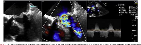 Figure 1 From A Case Of Bioprosthetic Mitral Valve Dysfunction