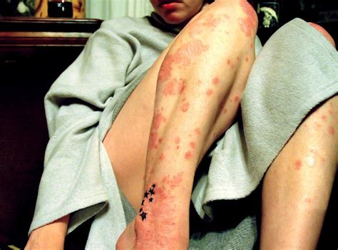 Psoriasis Symptoms Treatments And Causes