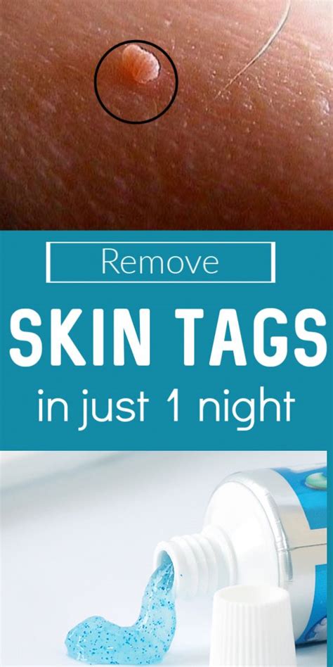 Remove Skin Tag In 1 Night After Applying This Paste Skincare