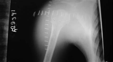 Plain Anteroposterior Radiograph Of Right Shoulder Showing Soft Tissue