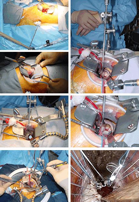 Mitral Valve Annuloplastyt Keio University Cardiovascular Surgery