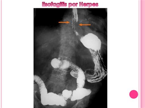 Serie Esofagogastroduodenal