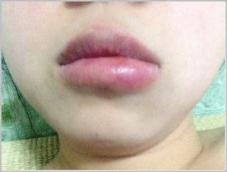 If you feel that a particular product. Swollen Lip: Causes (Including Allergic Reaction ...