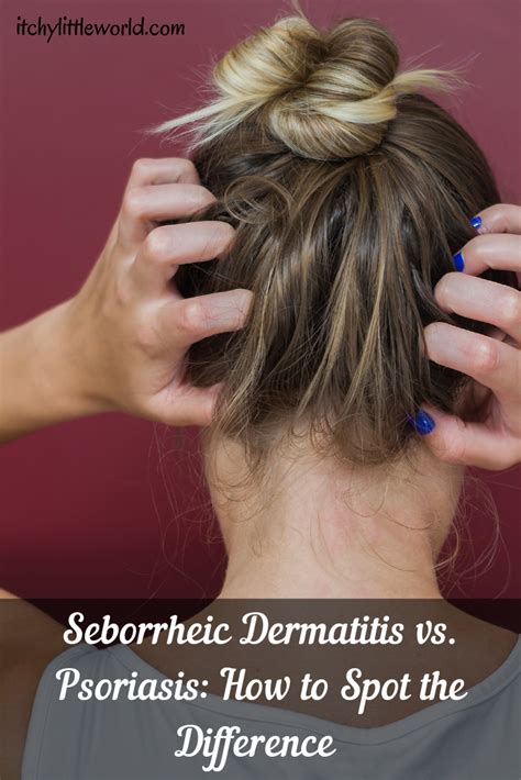 Scalp Psoriasis What You Need To Know Artofit