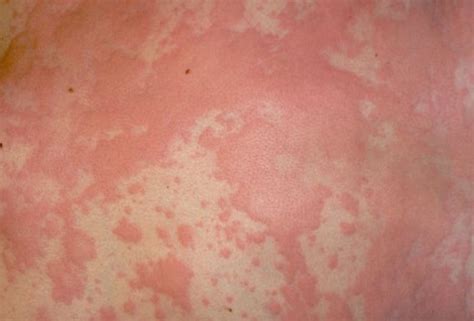 Hives Red Whelps On Neck Urticaria Fungal Rash Eczema Treatment
