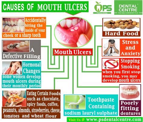 What Causes Mouth Ulcer Pictures Photos