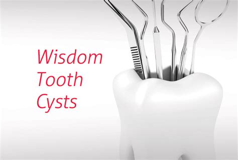 Wisdom Tooth Cyst Healthscope