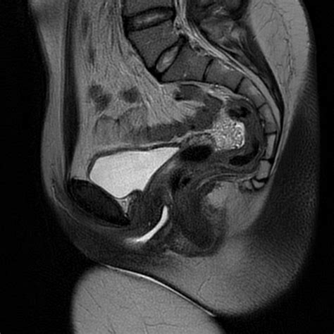 Bilateral True Hermaphroditism Image