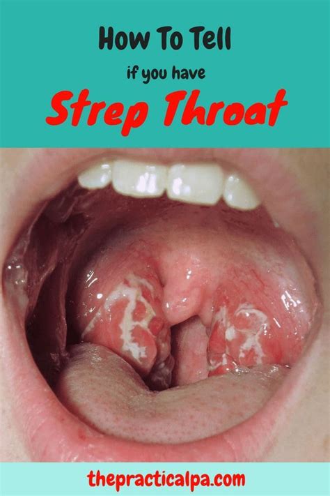 Strep Throat Symptoms And Top Treatment Tips Strep Throat Symptoms