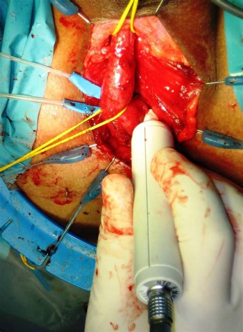 Reconstruction of Pelvic Fracture Urethral Injuries With ...