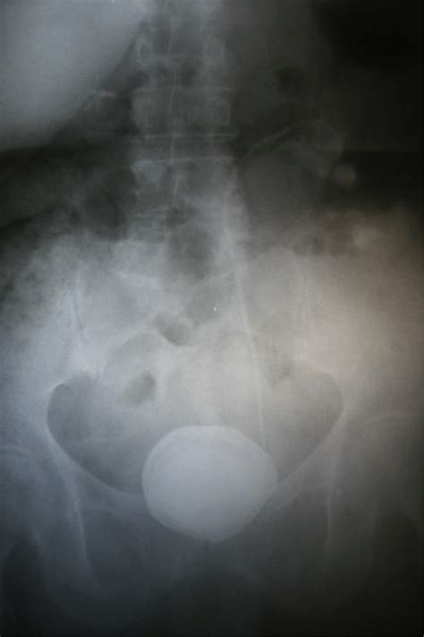 Plain Abdominal X Ray Showing The Bladder And Kidney Stones Download