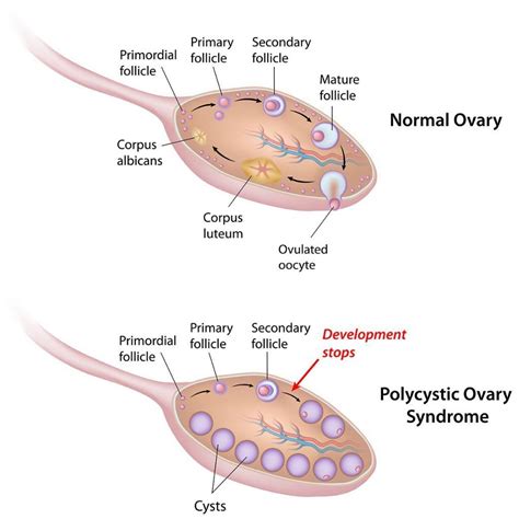 Polycystic Ovary Syndrome Can Cause Infrequent And Prolonged Menstrual