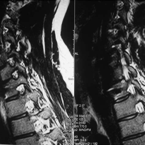 Pdf Oblique Mr Imaging In Cervical Spine Surgery