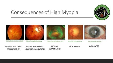 Myopia Risk Factor For Ocular Morbidity And Permanent Visual Loss