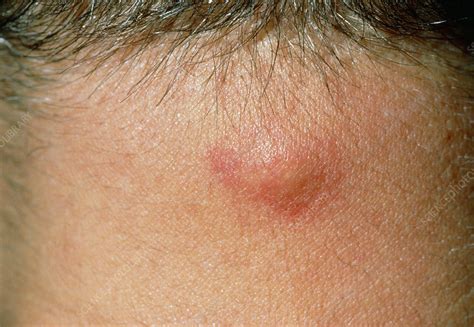 Close Up Inflamed Sebaceous Cyst On Male Neck Stock