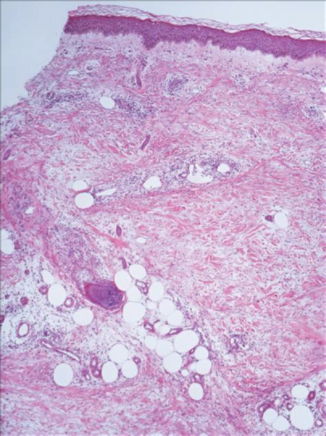 Eosinophilic Dermatoses Exaggerated Insect Bite Like Reaction