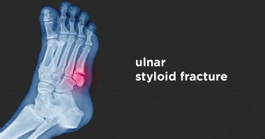 Ulnar Styloid Fractures Symptoms Causes Diagnosis And Vrogue Co