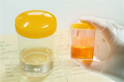 Check spelling or type a new query. Urine Drug Testing vs. Oral Fluid Testing: Which Is the ...