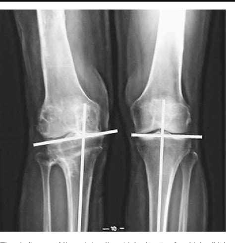 Computer Assisted Osteotomies For Genu Varum Deformity Which Osteotomy