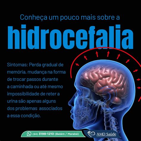 Hidrocefalia AMD Saúde