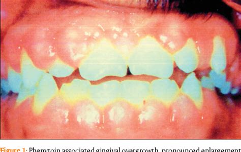 Figure 1 From Phenytoin Dilantin ‐ Associated Gingival Overgrowth